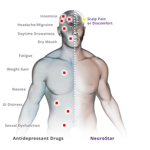 tms side effects