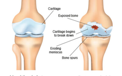 Relief from Knee Osteoarthritis Pain