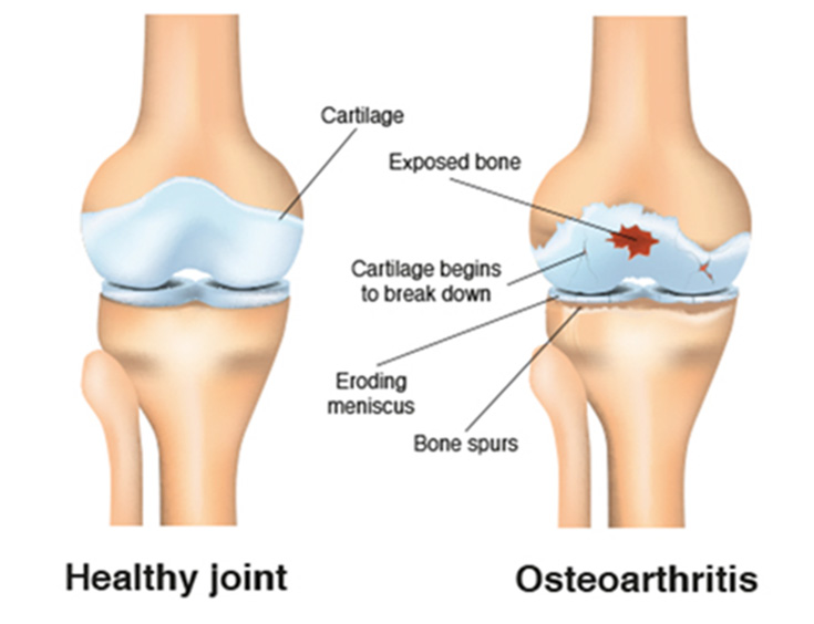 Relief from Knee Osteoarthritis Pain